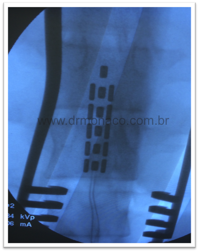 Radiografia de Neuroestimulador St. Jude do tipo 5-6-5 tripolar para tratamento de Síndrome Pós-Laminectomia - Dr. Bernardo de Monaco - 2014 - Failed Back Surgery Syndrome - Cirugia de Espalda Fallida